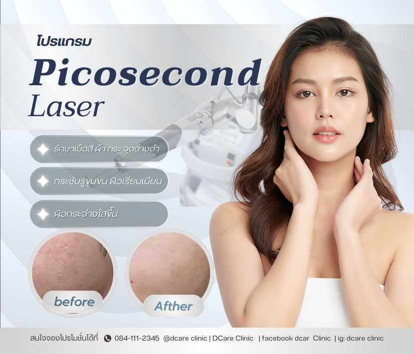 Picosecond Laser